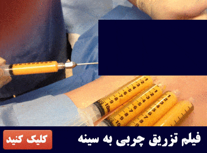 بهترین روش بزرگ کردن سینه