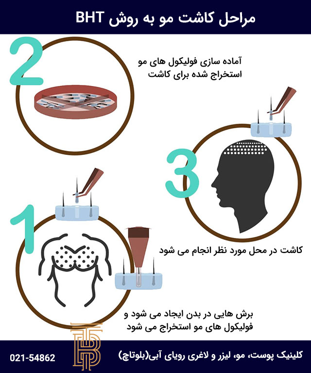 مراحل کاشت مو به روش bht