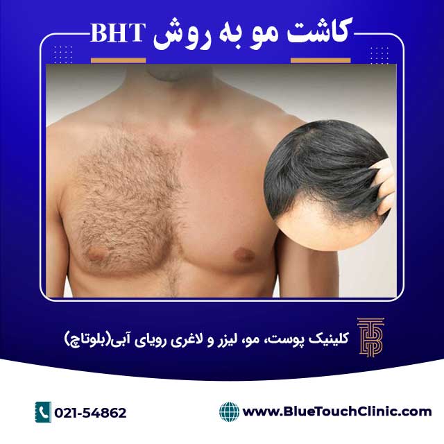 کاشت مو به روش bht