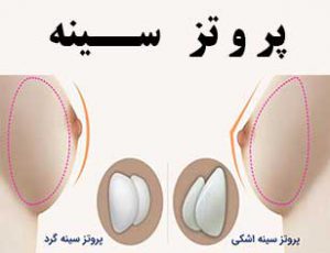 انواع پروتز سینه، ماندگاری، مزایا، عوارض و هزینه کاشت