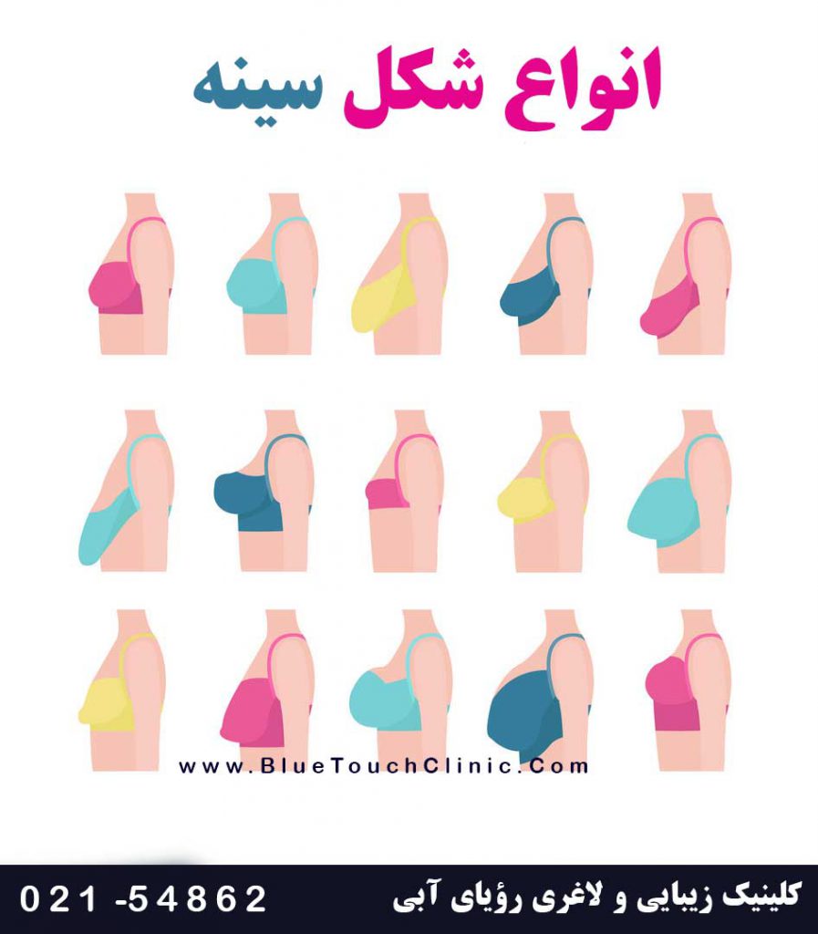 انواع پروتز سینه، ماندگاری، مزایا، عوارض و هزینه کاشت