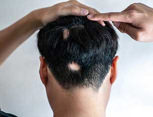 علت ریزش موی سکه ای چیست و آیا درمانی دارد؟