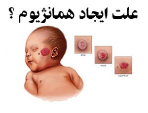 علت ایجاد همانژیوم و راههای درمان آن چیست