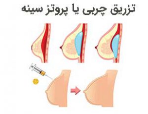 تزریق چربی به سینه بهتره یا پروتز سینه؟