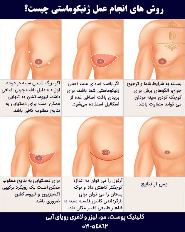 روش های انجام عمل جراحی کوچیک کردن سینه یا ژنیکوماستی
