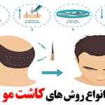 انواع روش کاشت مو، هزینه، معایب و مزایای هر کدام