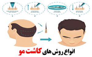 انواع روش کاشت مو، هزینه، معایب و مزایای هر کدام