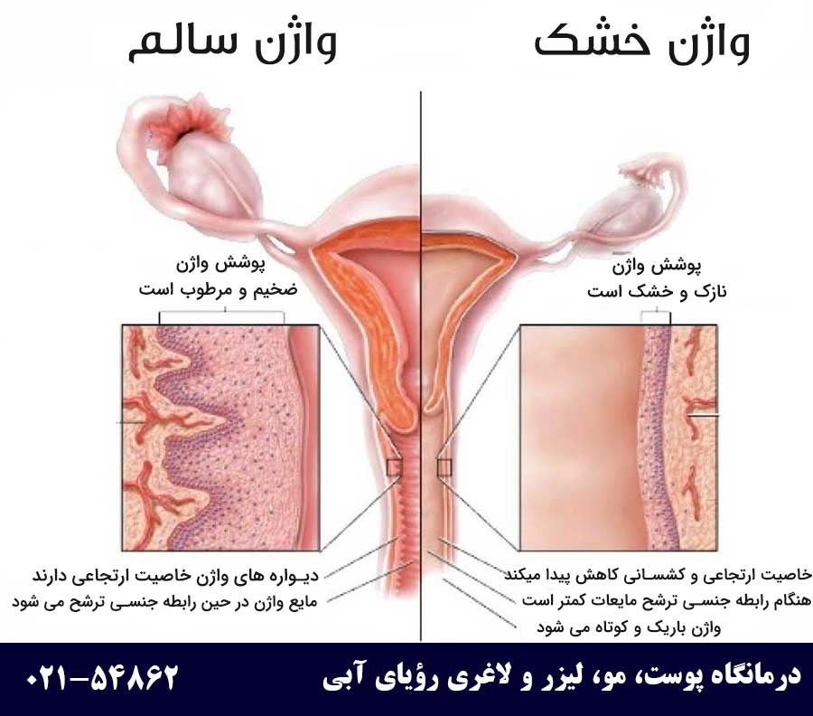 آتروفی واژن چیست