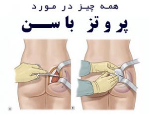 پروتز باسن، بهترین راه بزرگ کردن باسن