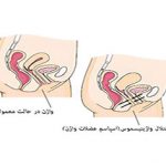 واژینیسموس یا دخول دردناک چیست و چگونه درمان می شود