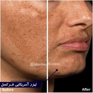 قبل و بعد از یک جلسه استفاده از لیزر آمریکایی فرکسل جهت بهبود لک‌های پوستی