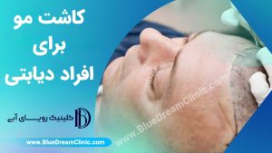 کاشت مو برای افراد دیابتی