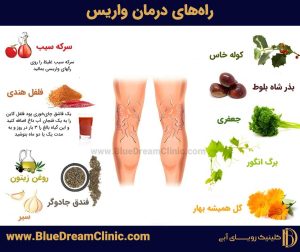 راههای درمان واریس در خانه