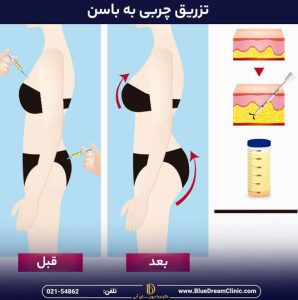 تزریق چربی به باسن چیست