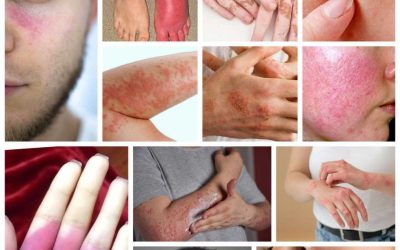 شایع ترین بیماری‌های پوستی + علائم و درمان آنها
