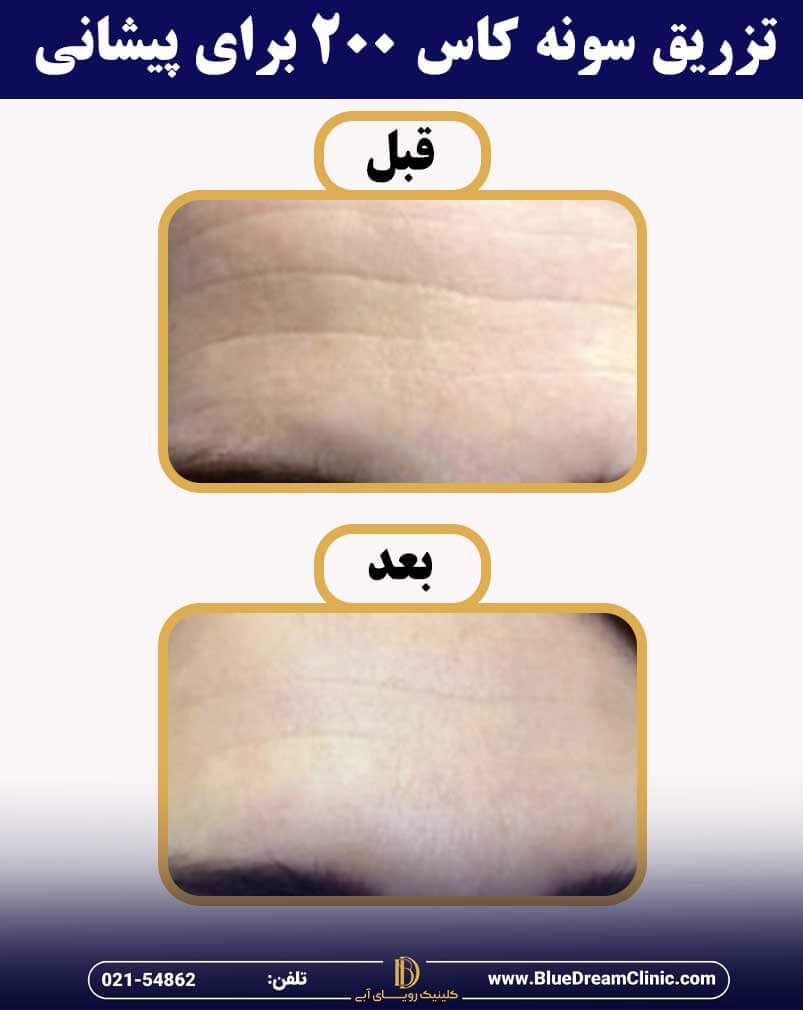 عکس قبل و بعد از تزریق سونه کاس پیشانی
