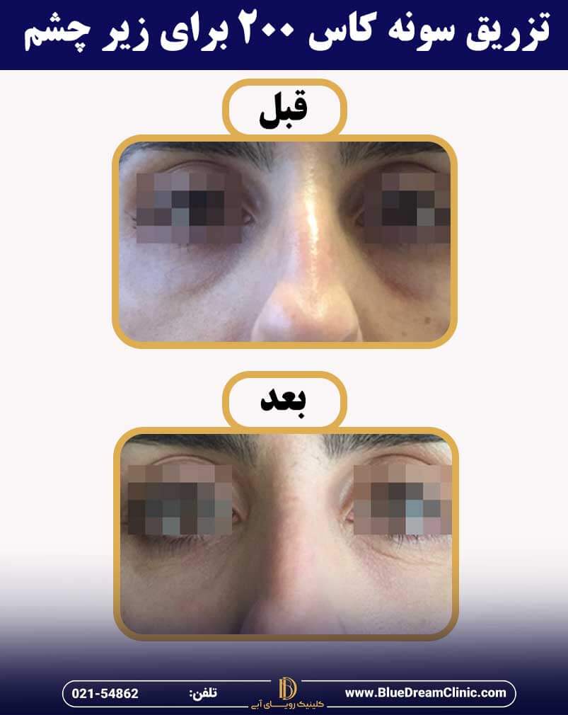 عکس قبل و بعد از تزریق سونه کاس زیر چشم