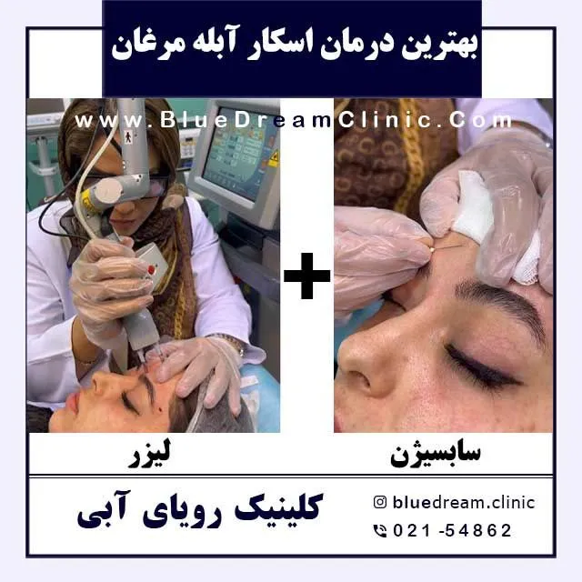 لیزر جای آبله مرغان