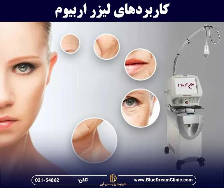 لیزر ابیوم چیست و چه کاربردی دارد