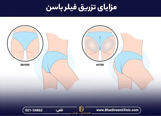 مزایای تزریق فیلر بادی