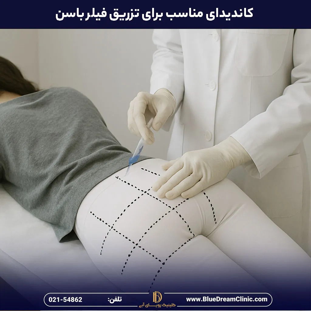 کاندیدای مناسب تزریق فیلر باسن
