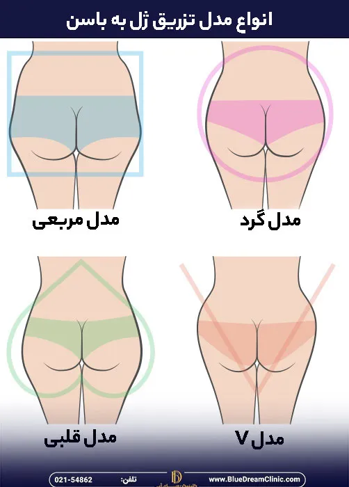 انواع مدل تزریق فیلر به باسن