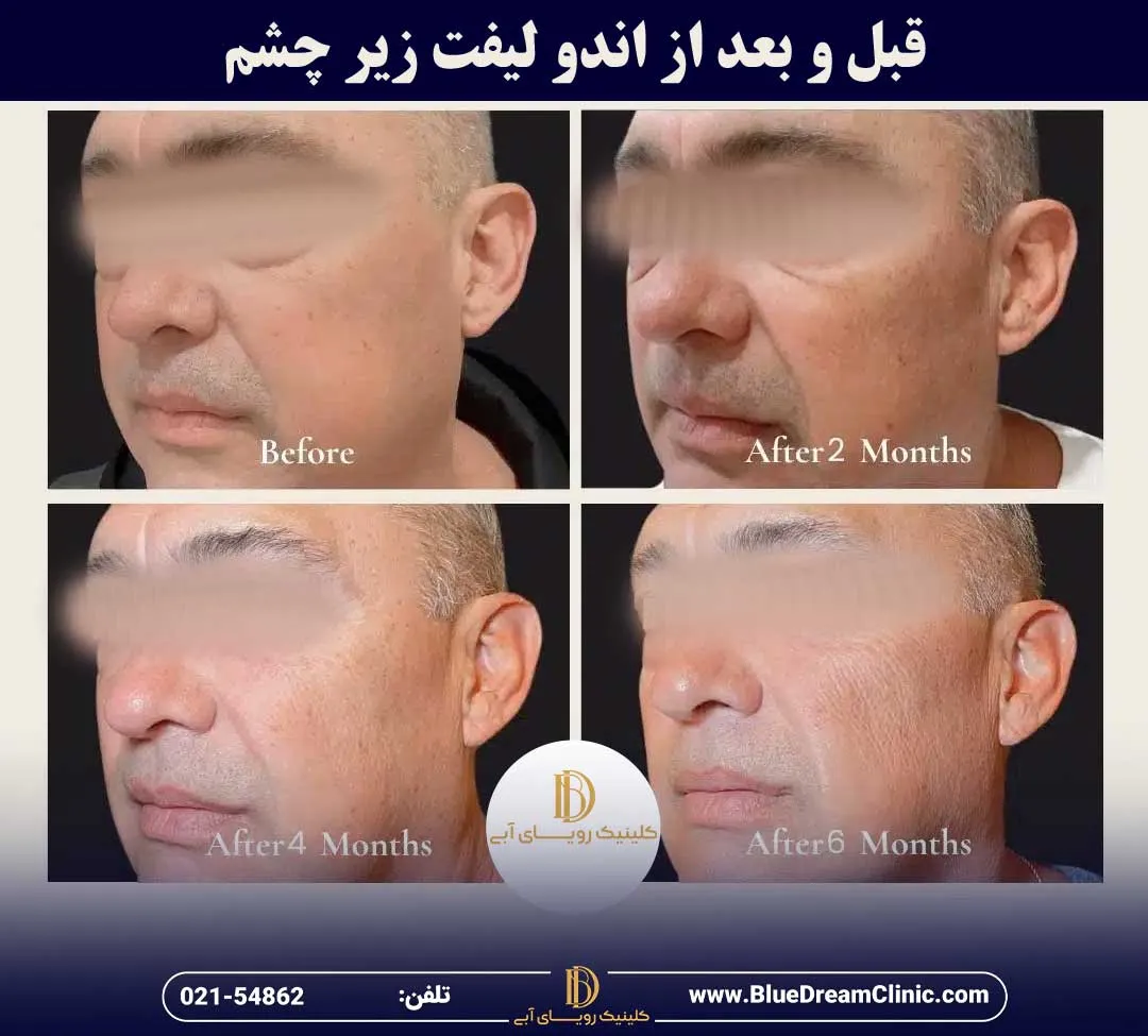 قبل و بعد از اندولیفت زیر چشم