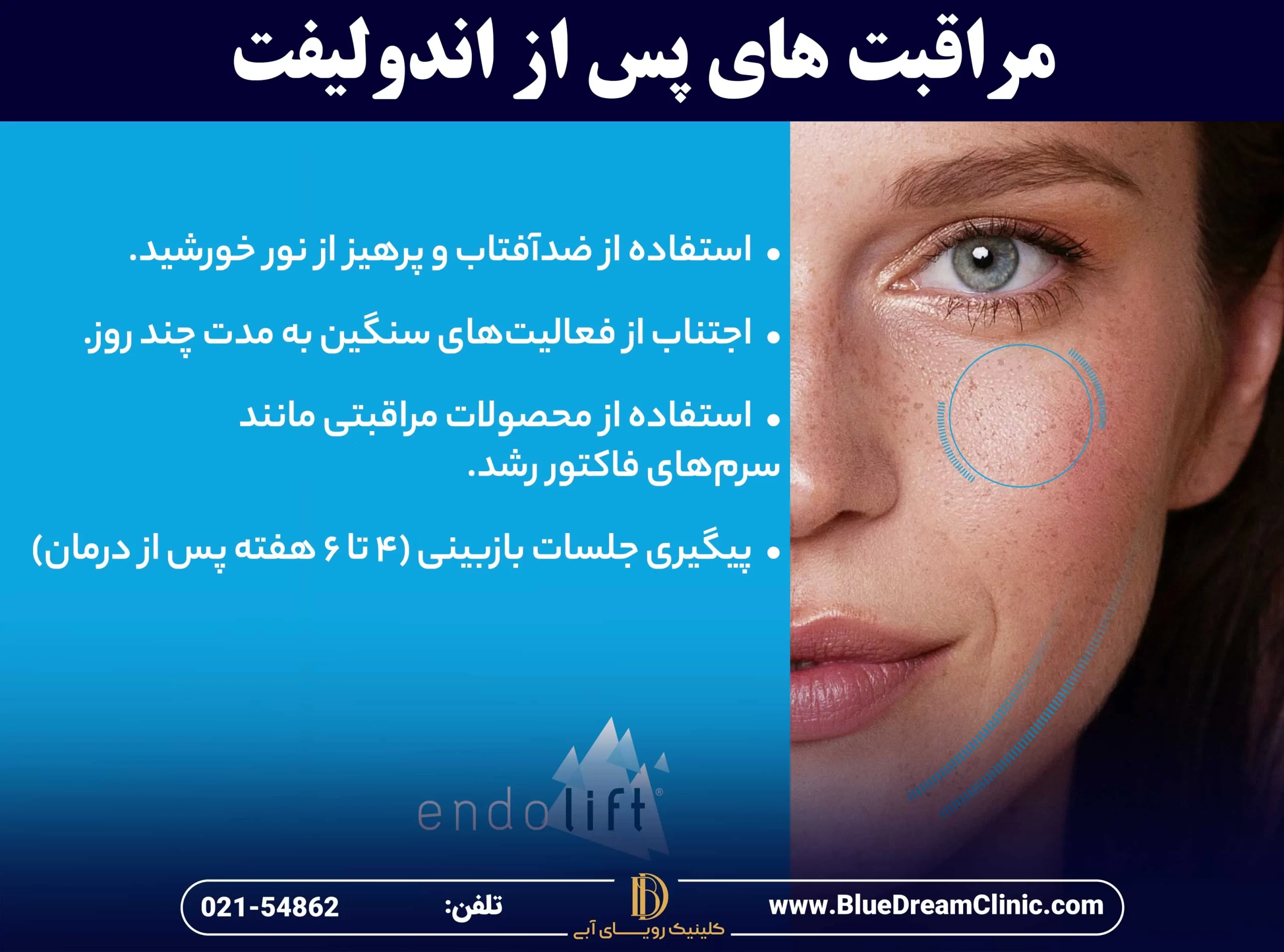 مراقبت های لازم بعد از اندولیفت