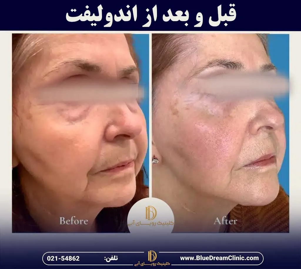 قبل و بعد از اندولیفت صورت