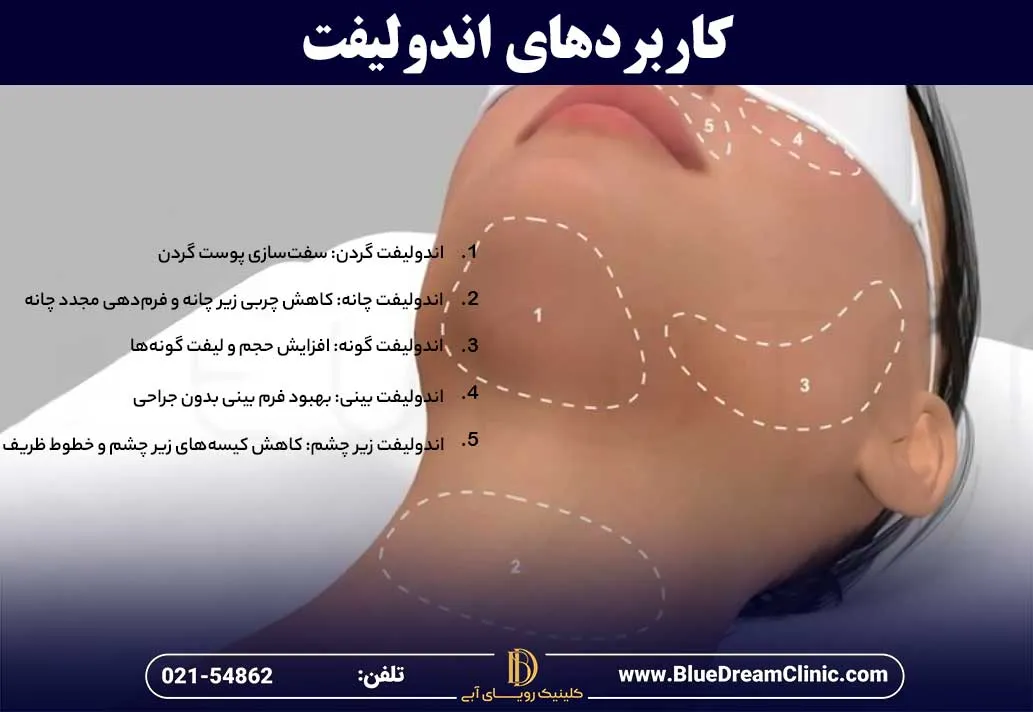 کاربردهای اندولیفت