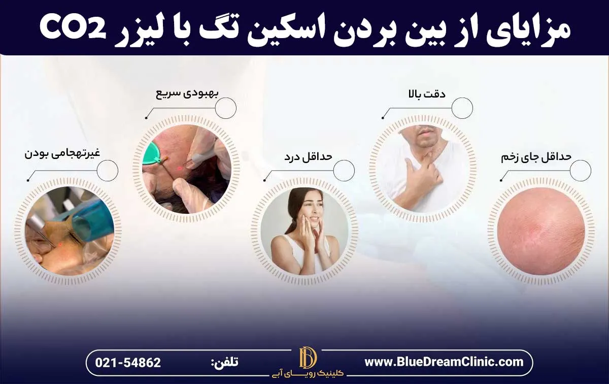 مزایای از بین بردن اسکین تگ با لیزر co2