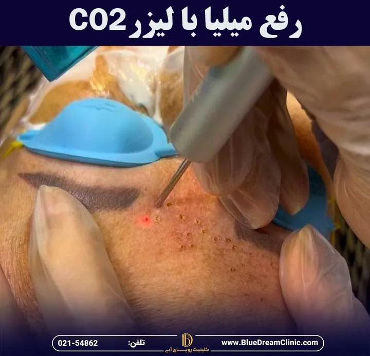 از بین بردن میلیا با لیزر