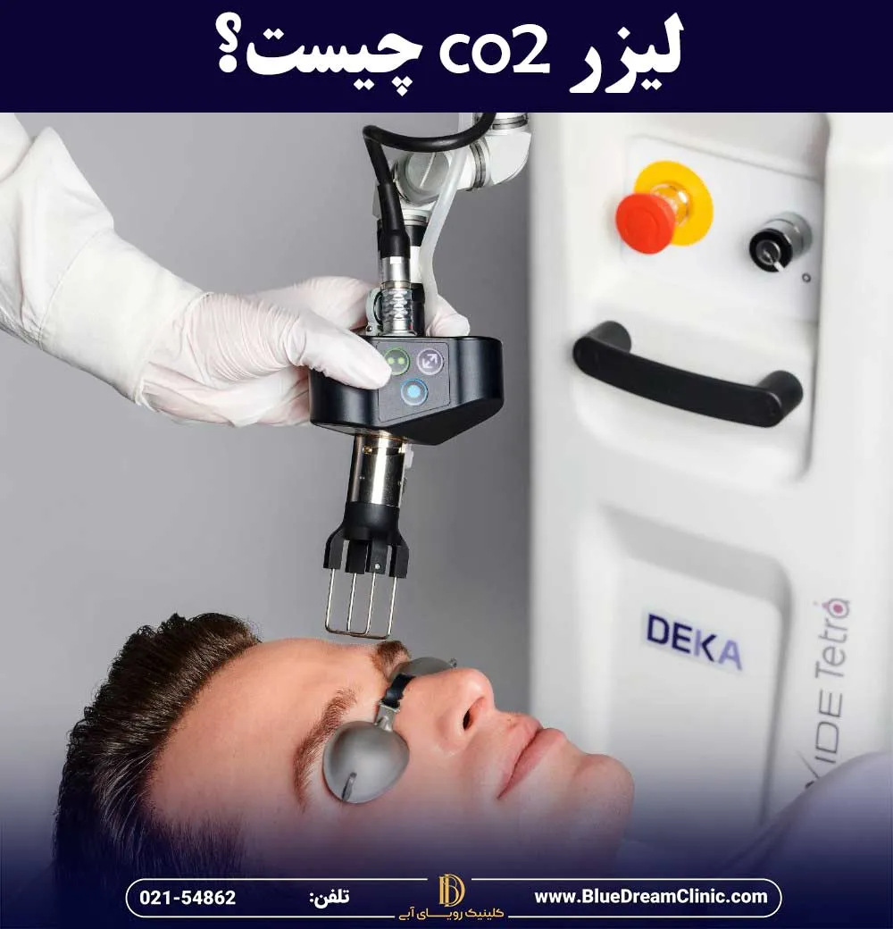 لیزر co2 چیست