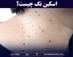 اسکین تگ چیست