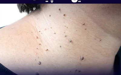 اسکین تگ یا منگوله پوستی چیست؛ علل، علائم و درمان‌ها