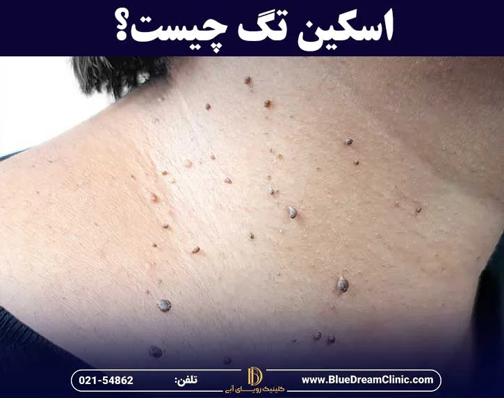 اسکین تگ یا منگوله پوستی چیست
