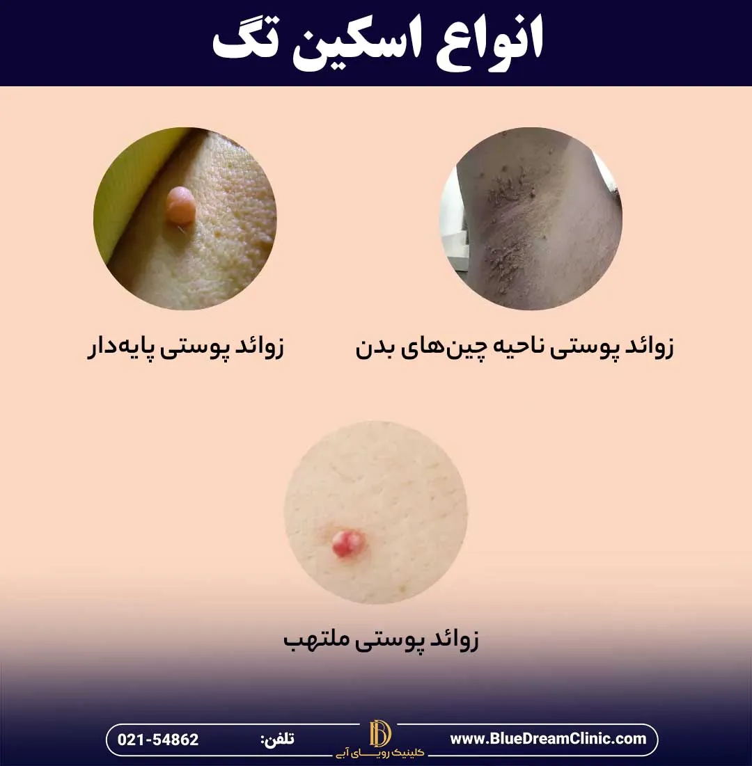 انواع اسکین تگ
