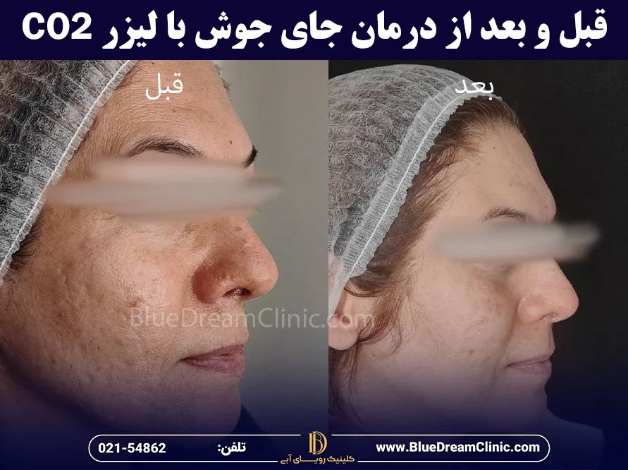 عکس قبل و بعد از درمان جای جوش با لیزر co2