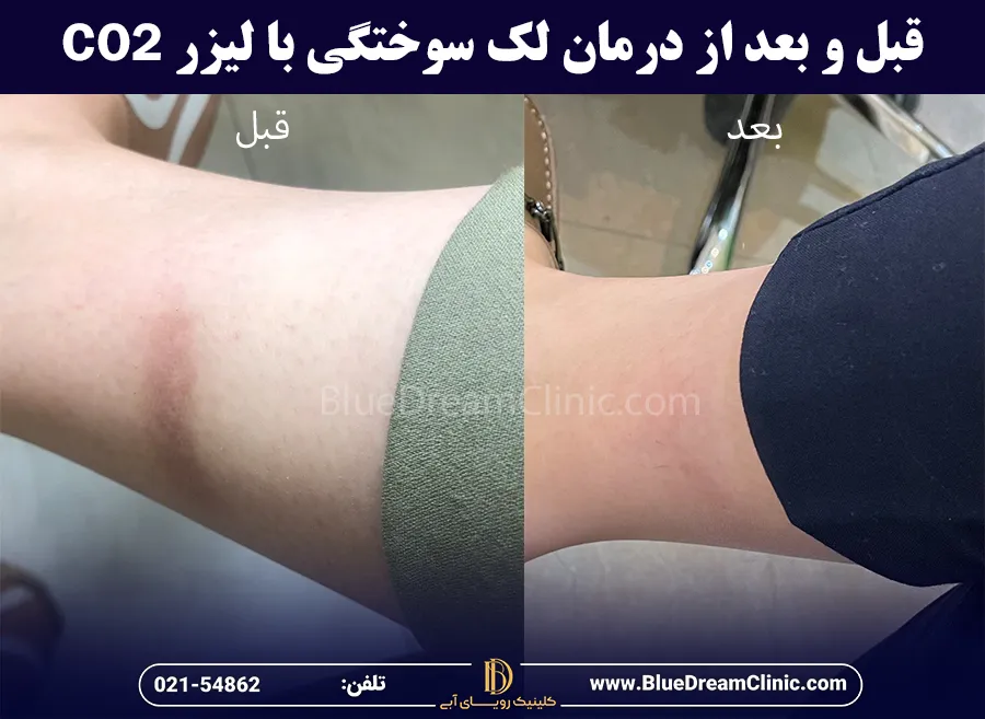 قبل و بعد از درمان لک سوختگی با لیزر co2 فرکشنال