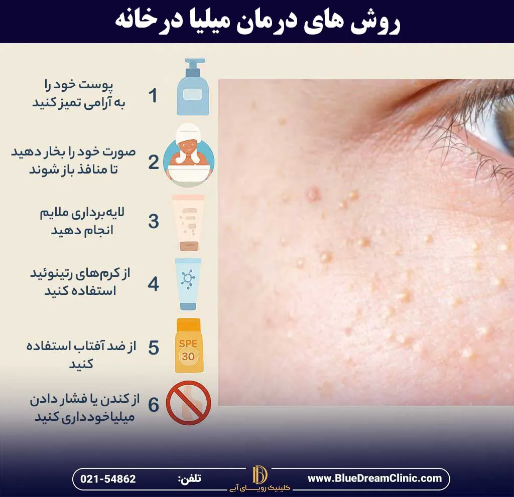 روش های درمان میلیا در خانه