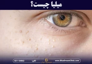 میلیا چیست