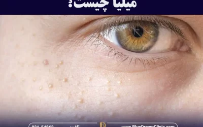 میلیا چیست؟ علت، پیشگیری و درمان با لیزر و ماسک خانگی