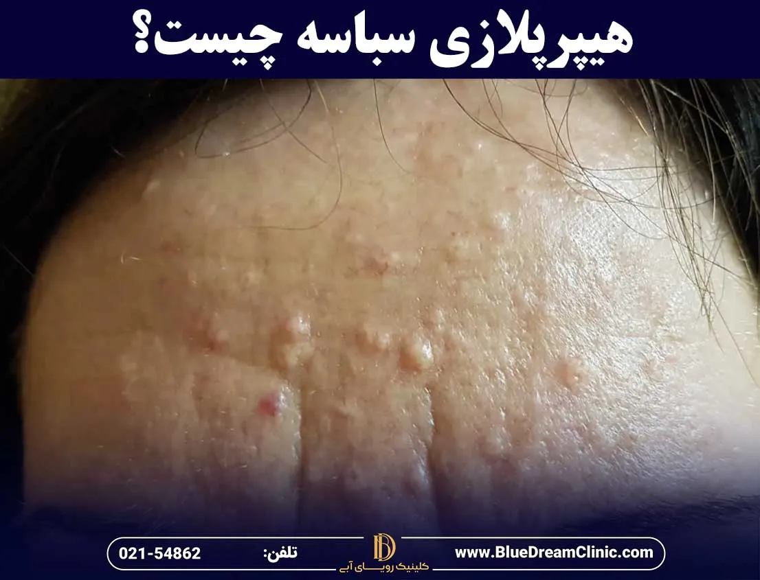 هایپرپلازی چیست