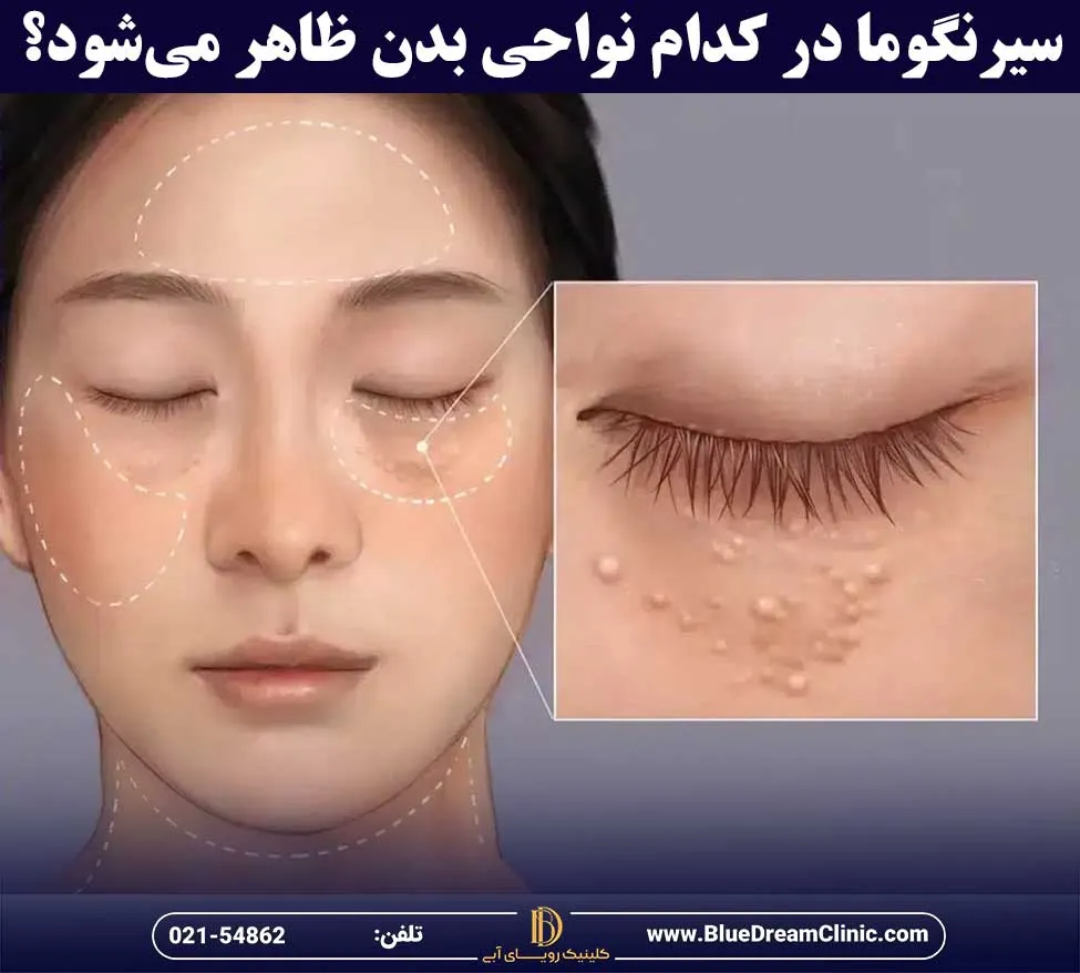 سیرنگوما چیست