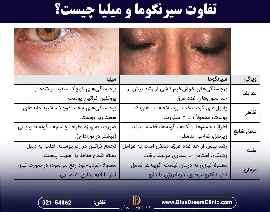 تفاوت سیرنگوما و میلیا