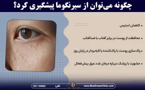 راههای پیشگیری از سیرنگوما اطراف چشم