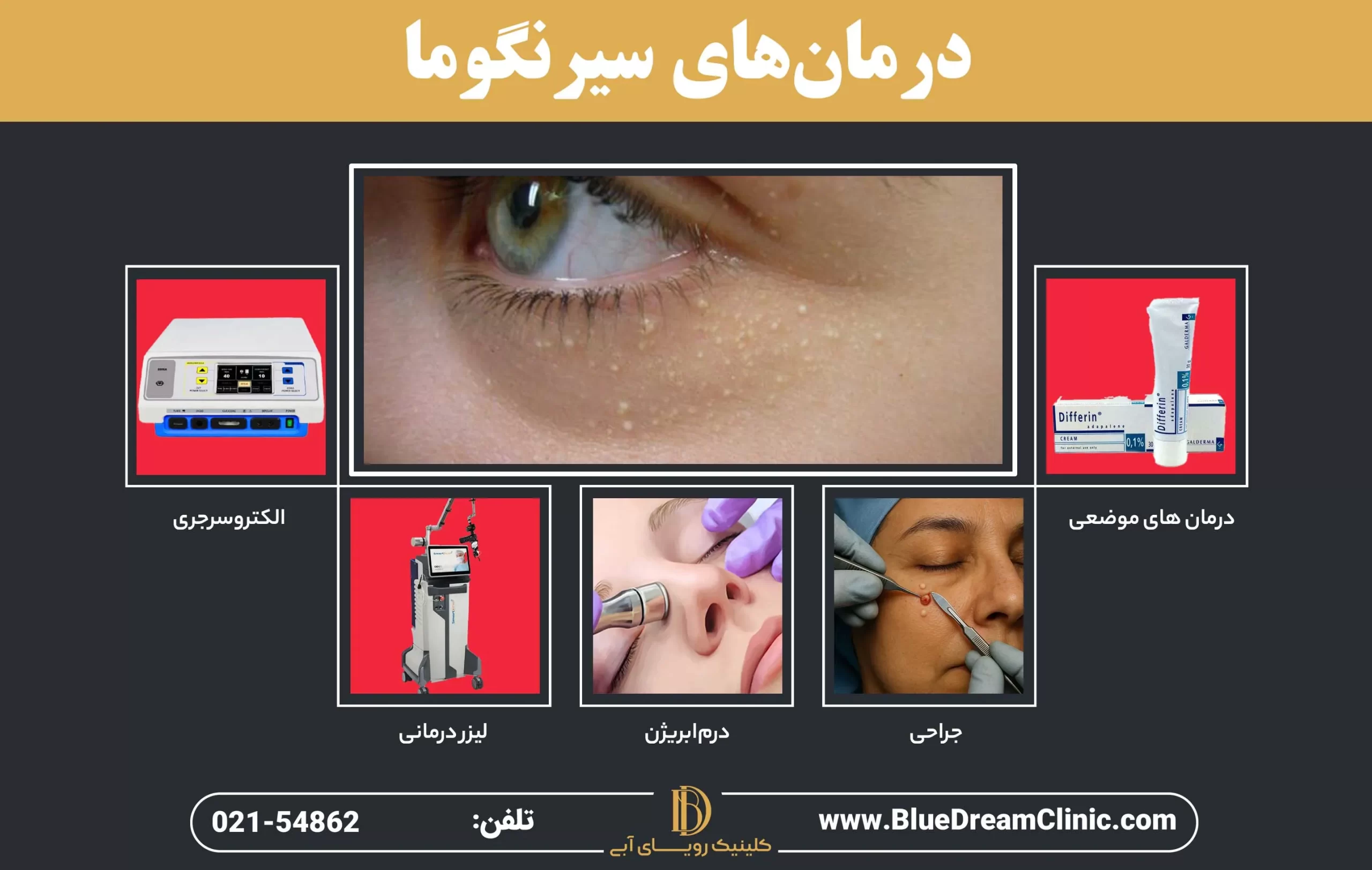 راههای درمان سیرنگوما